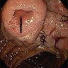 Endoscopy