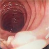 Endoscopy