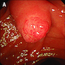 Endoscopy