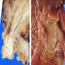 Papillary / polypoid mass