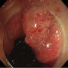 Irregular mucosa and angioectasia