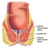 Schematic image representing internal and external hemorrhoids
