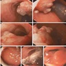 Polypoid lesion on colonoscopy