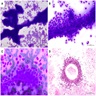 Metastatic melanoma smears