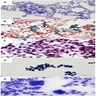 Metastatic melanoma smears