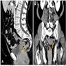 Anorectal mass (CT of pelvis)