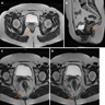 Anorectal mass (MRI)