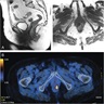 Anorectal mass (MRI / PET)
