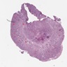 Malignant infiltrative epithelioid cells