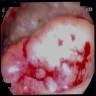 Anorectal ulcerated mass