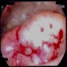 Anorectal ulcerated mass