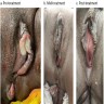 Exophytic perineal lesions