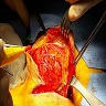 Posterior approach view of tailgut cyst, intraoperative photograph