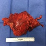Tailgut cyst, intact resection