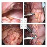 Adenocarcinoma involving appendix