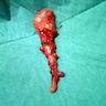 Multiple appendiceal diverticula