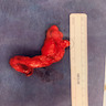 Congenital appendiceal diverticulum