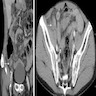 Oblique coronal reformation of contrast enhanced CT scan