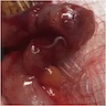 <i>Enterobius vermicularis</i> through appendix