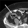 CT demonstrating an intraluminal tubular structure