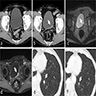 CT and MRI urothelial carcinoma