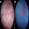 White light cystoscopy