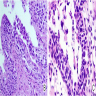 CIS involving ureteral margin