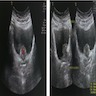 Bladder neck mass by ultrasound 