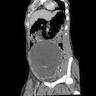 Low attenuating cystic mass