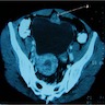 Mass in the anterior abdominal wall