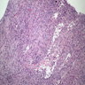 Granulomatous cystitis, postresection