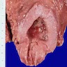 Inflamed mucosa