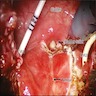 Robot assisted laparoscopic findings