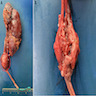 Nephroureterectomy