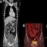 Coronal contrast enhanced CT, MIBG scan