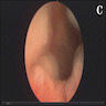 Cystoscopic findings