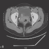 Axial contrast enhanced CT