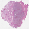 Encapsulated bladder paraganglioma