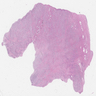Bladder paraganglioma with infiltrative pattern