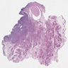 Urothelial carcinoma with sarcomatoid differentiation, high grade