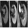 T1 precontrast demonstrates isoechoic mass