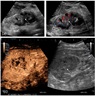 Ultrasound shows mass-like hyperechoic area
