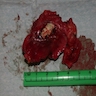 Infected urachal cyst and fibrous tract
