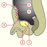 Urachal cysts and fistulas