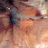 Urachal cysts - sinus tract between bladder dome and umbilicus