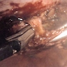 Urachal cysts - sinus tract between bladder dome and umbilicus