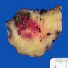 Inflamed urachal cyst