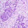 Urothelial carcinoma in situ in frozen section