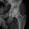 Xray of femoral head AVN