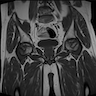 MRI of bilateral AVN